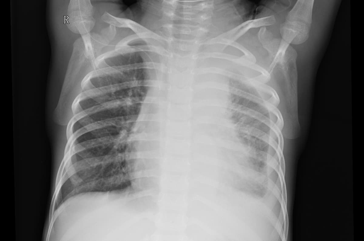 Pneumonia — NIH Chest X-ray14