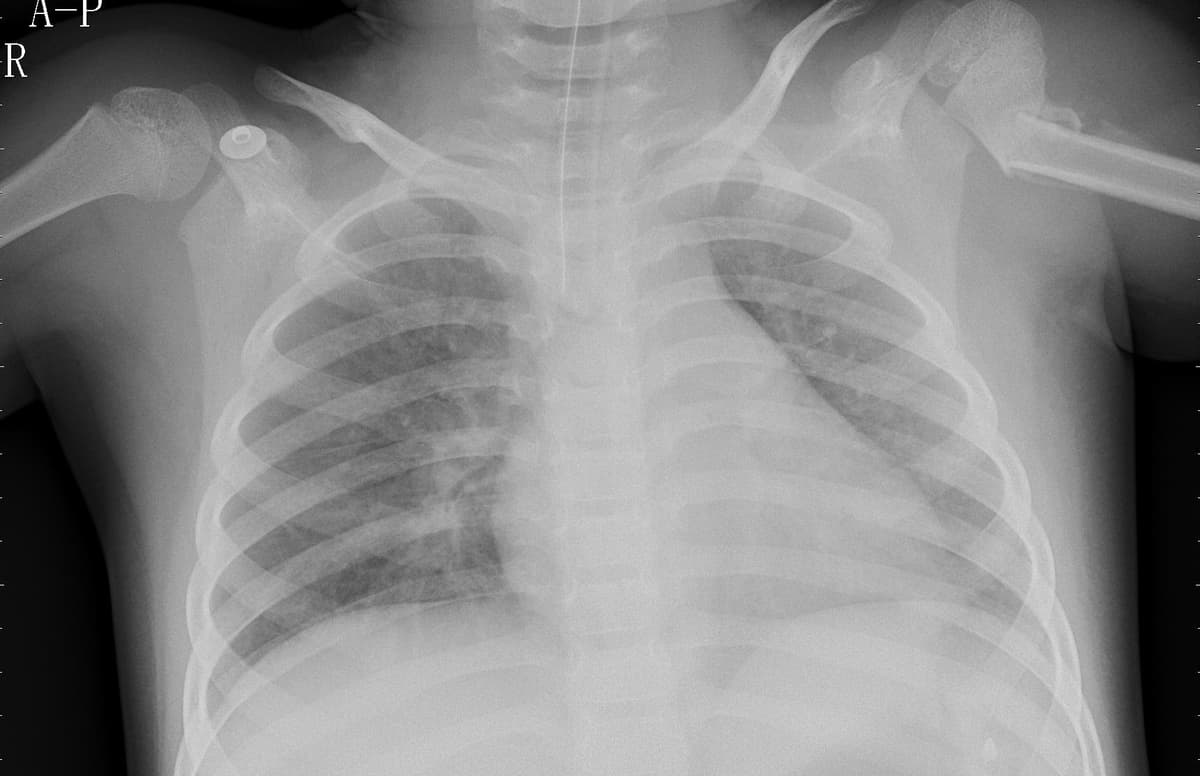 Pneumonia — NIH Chest X-ray14