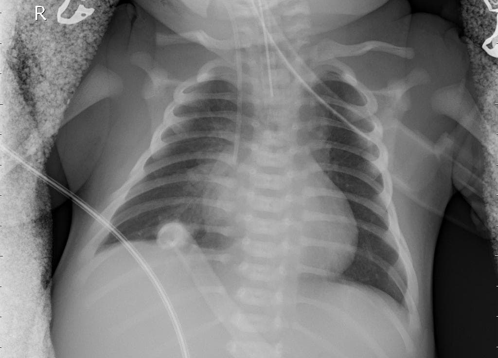 Pneumonia — NIH Chest X-ray14