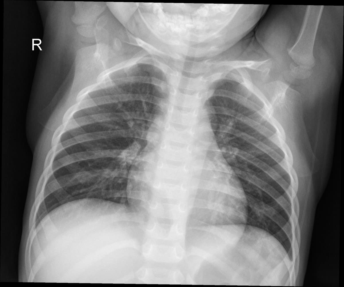 Radiografia Normal — NIH Chest X-ray14
