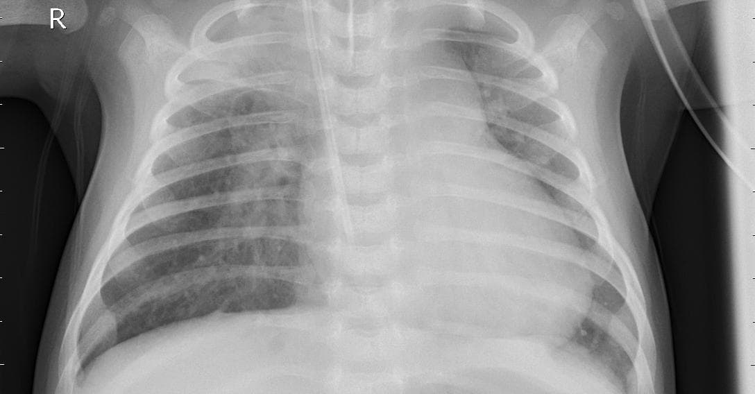 Pneumonia — NIH Chest X-ray14