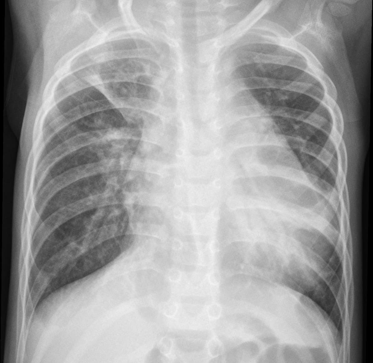 Pneumonia — NIH Chest X-ray14