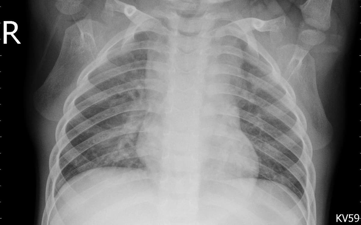 Pneumonia — NIH Chest X-ray14