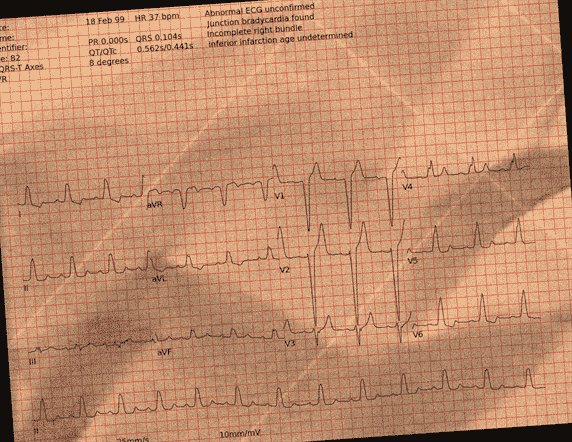 Normal ECG — PTB-XL