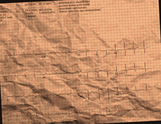 Normal ECG — PTB-XL