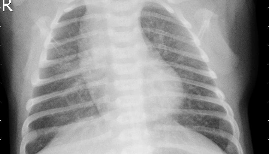 Pneumonia — NIH Chest X-ray14