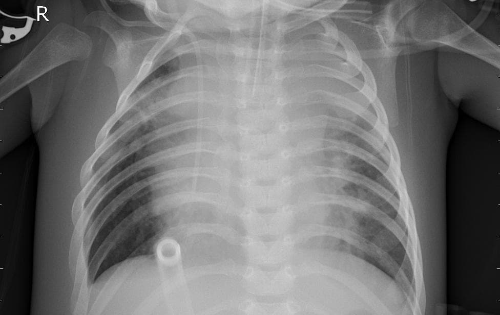 Pneumonia — NIH Chest X-ray14