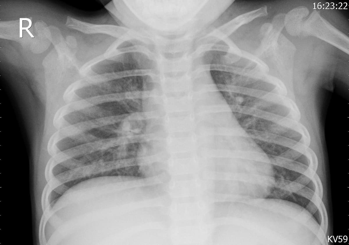Pneumonia — NIH Chest X-ray14
