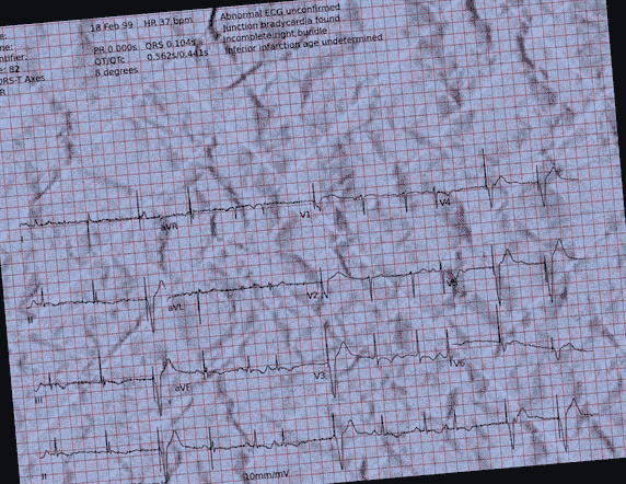 Normal ECG — PTB-XL