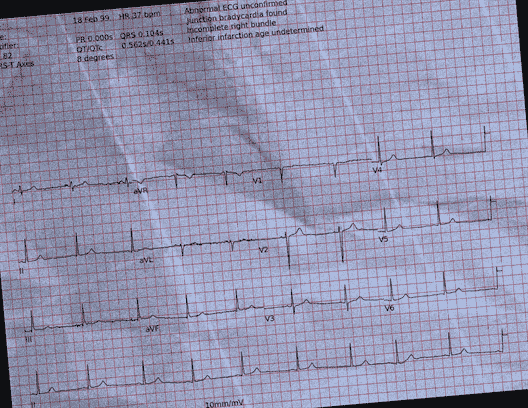 Normal ECG — PTB-XL