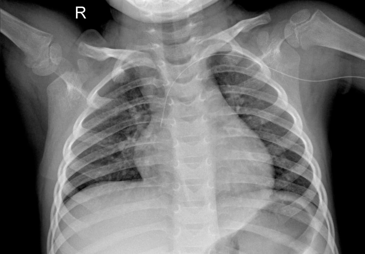 Radiografia Normal — NIH Chest X-ray14