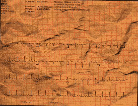 Normal ECG — PTB-XL