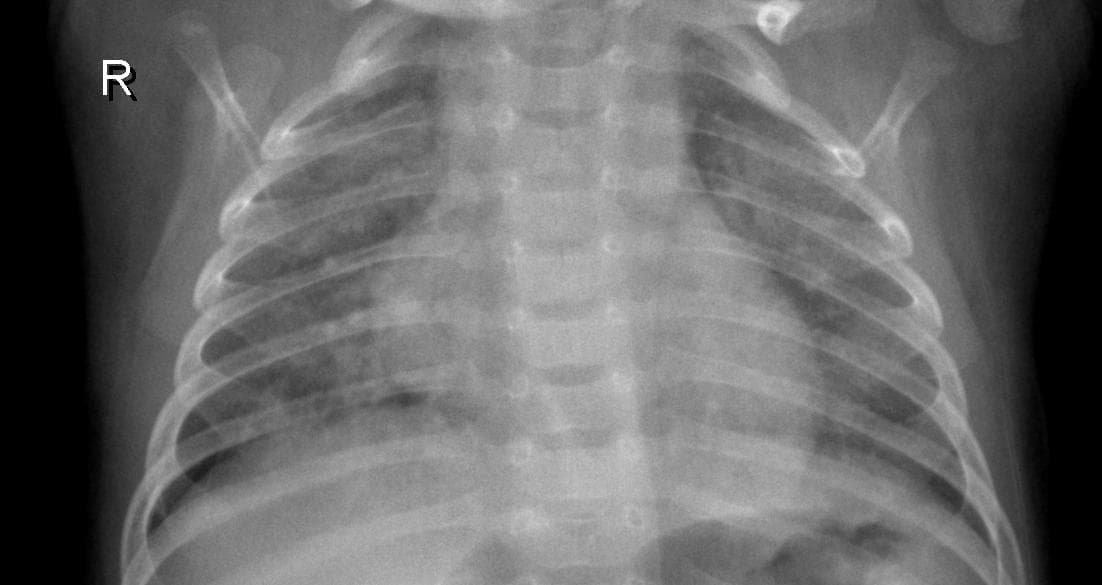 Pneumonia — NIH Chest X-ray14