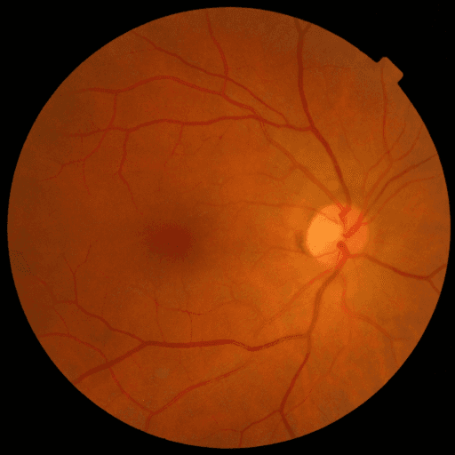 No Diabetic Retinopathy — MESSIDOR-2