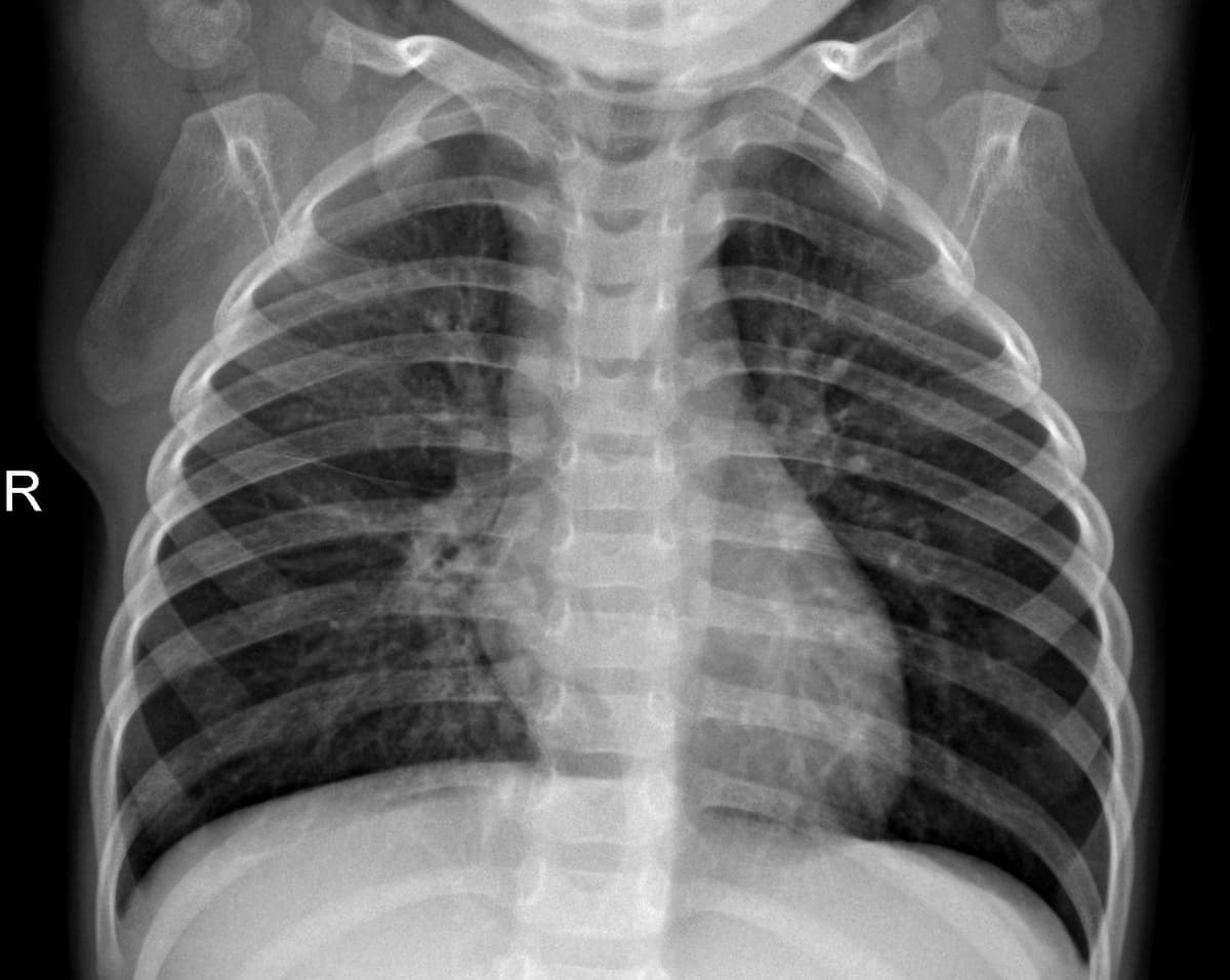 Pneumonia — NIH Chest X-ray14