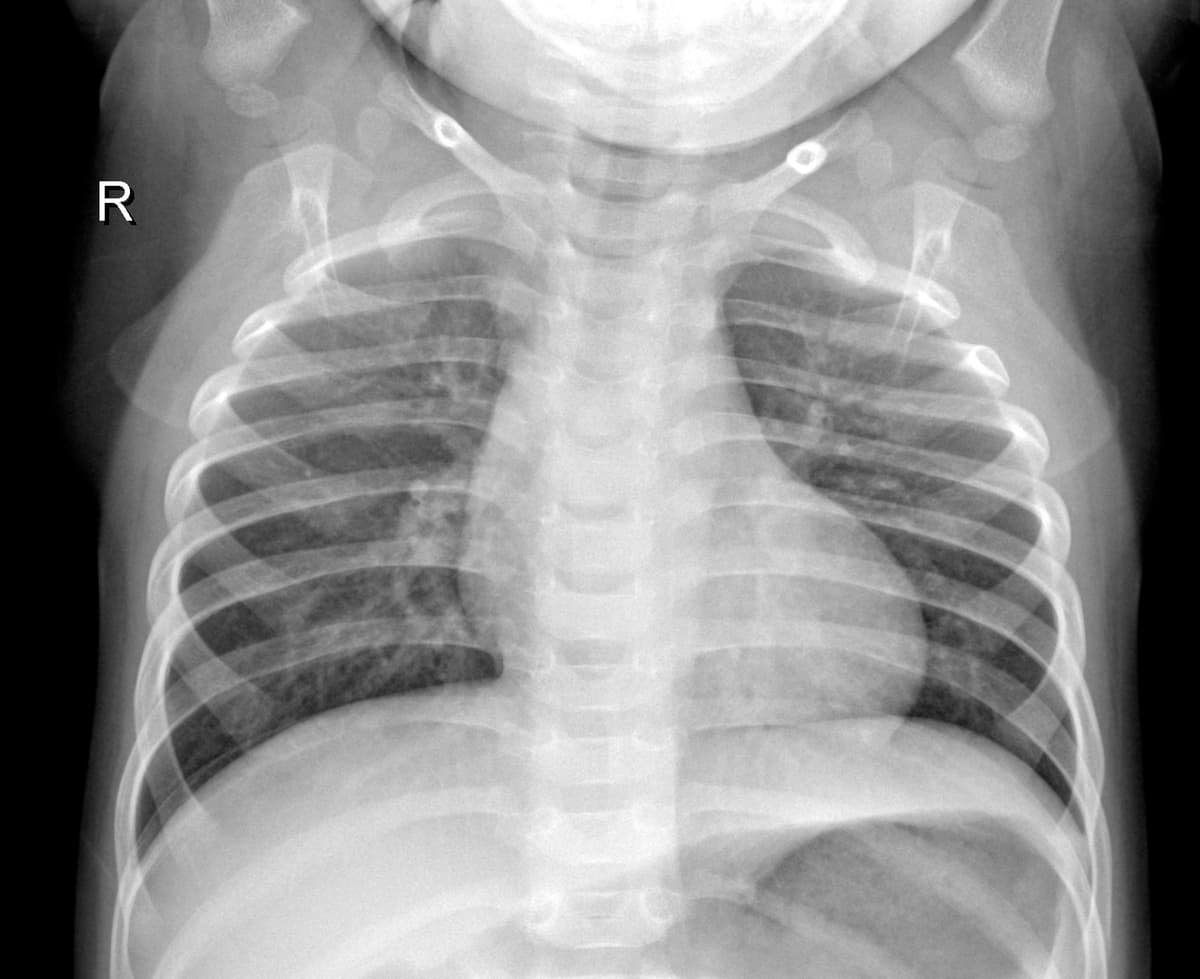Radiografia Normal — NIH Chest X-ray14