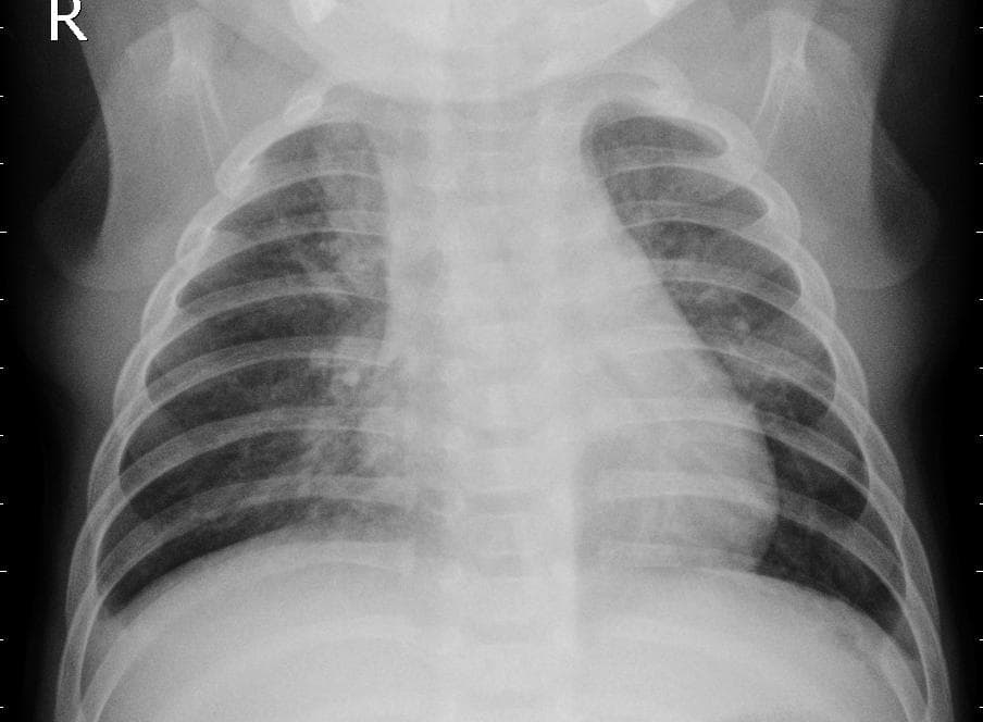Pneumonia — NIH Chest X-ray14