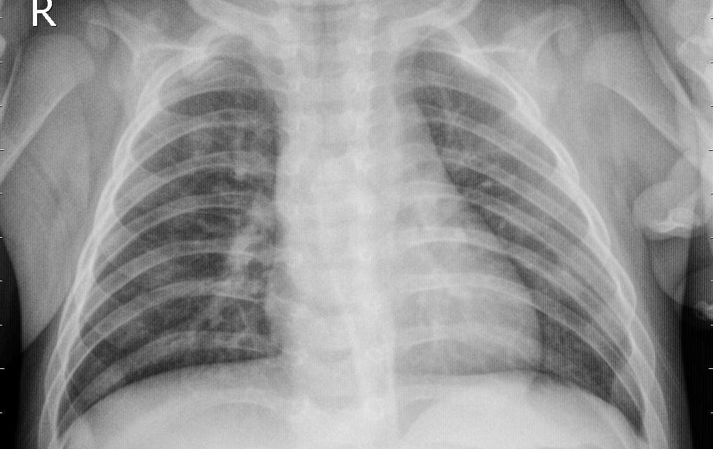 Pneumonia — NIH Chest X-ray14