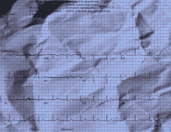 Normal ECG — PTB-XL