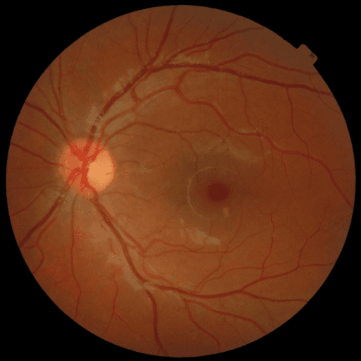 No Diabetic Retinopathy — MESSIDOR-2