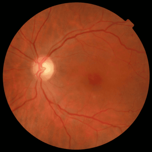 No Diabetic Retinopathy — MESSIDOR-2