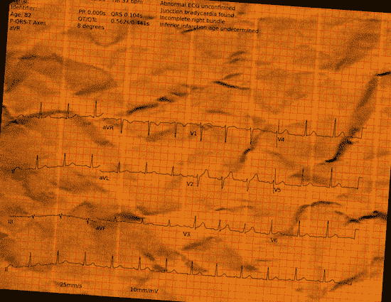 Normal ECG — PTB-XL