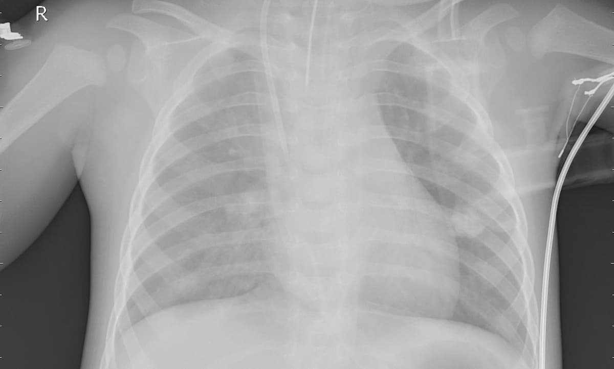 Pneumonia — NIH Chest X-ray14
