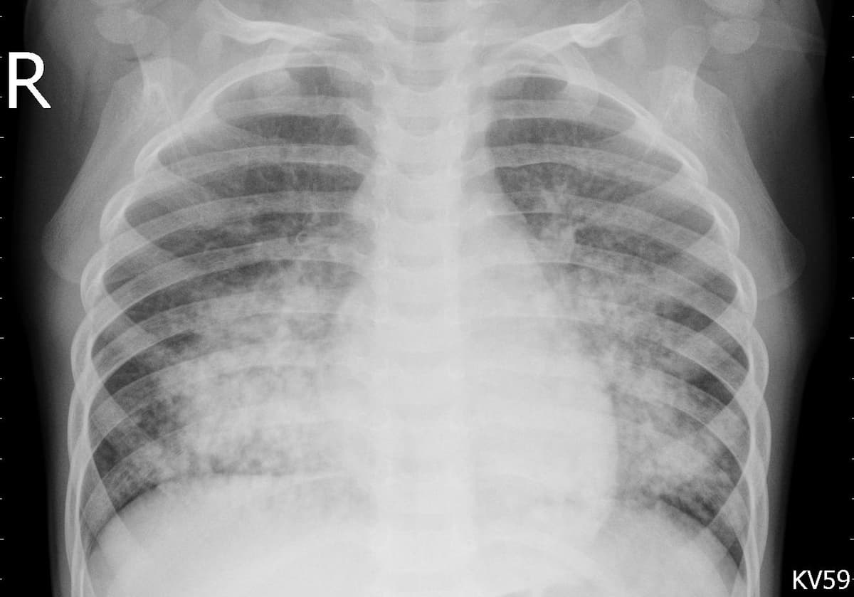 Pneumonia — NIH Chest X-ray14