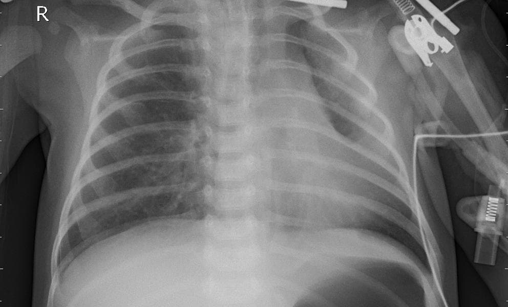 Pneumonia — NIH Chest X-ray14