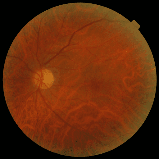 No Diabetic Retinopathy — MESSIDOR-2