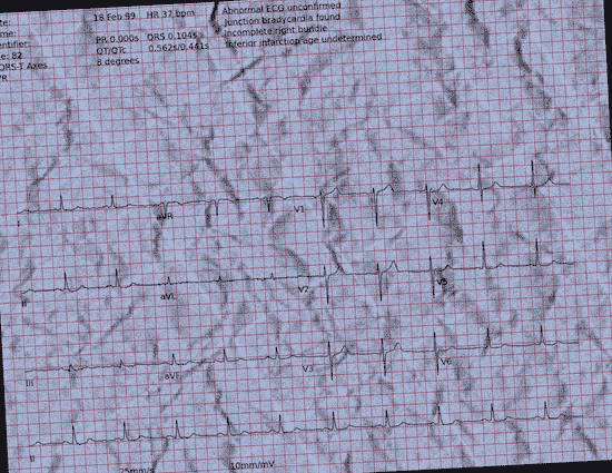 Normal ECG — PTB-XL