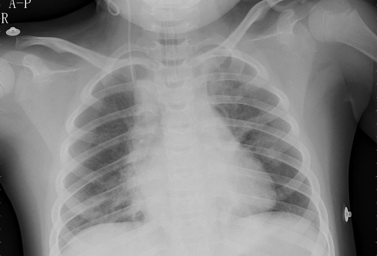 Pneumonia — NIH Chest X-ray14