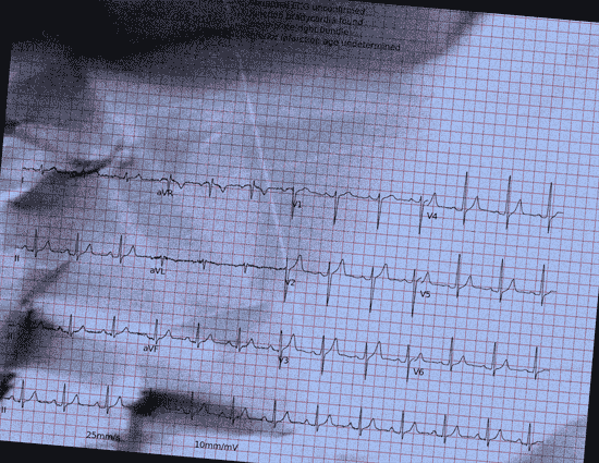 Normal ECG — PTB-XL