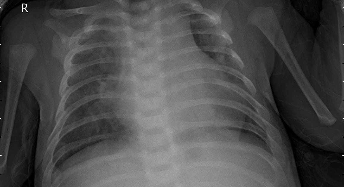 Pneumonia — NIH Chest X-ray14