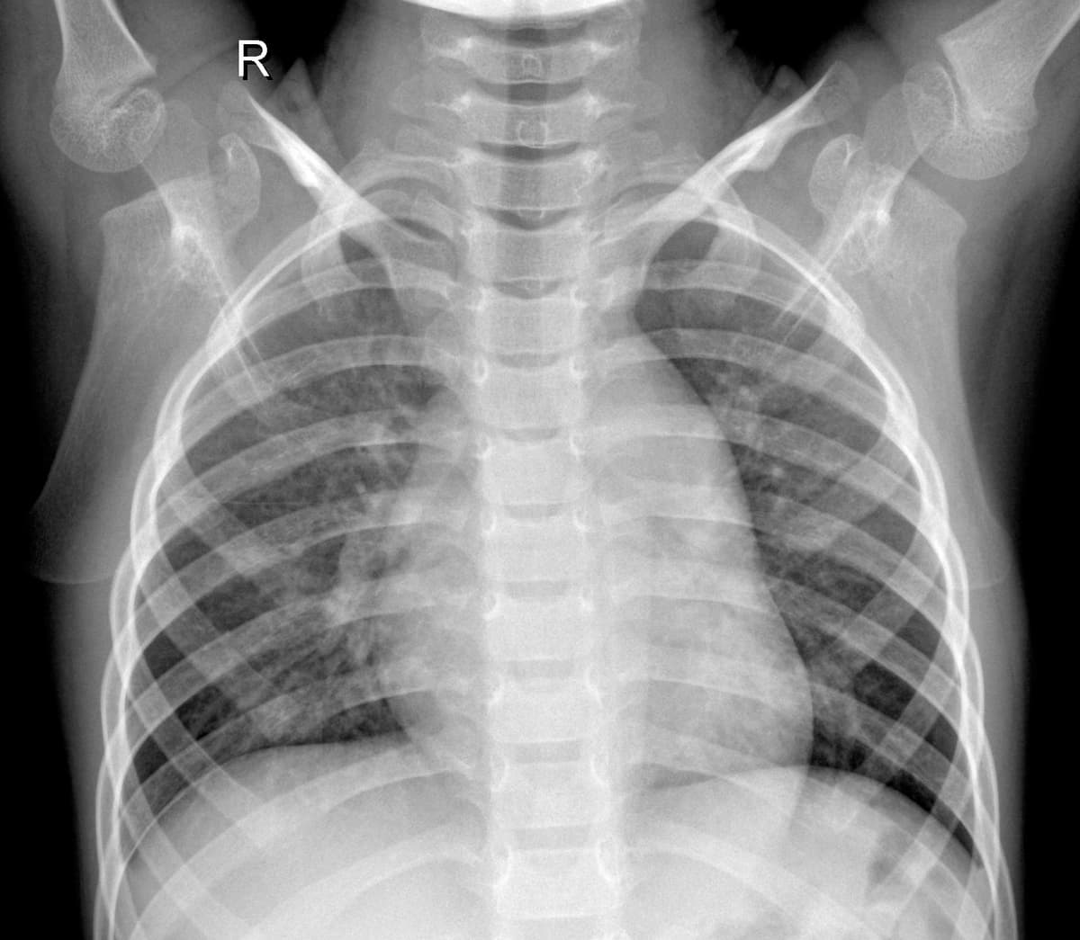 Radiografia Normal — NIH Chest X-ray14