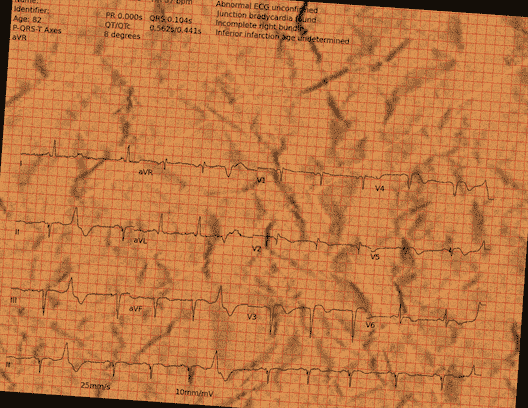 Normal ECG — PTB-XL