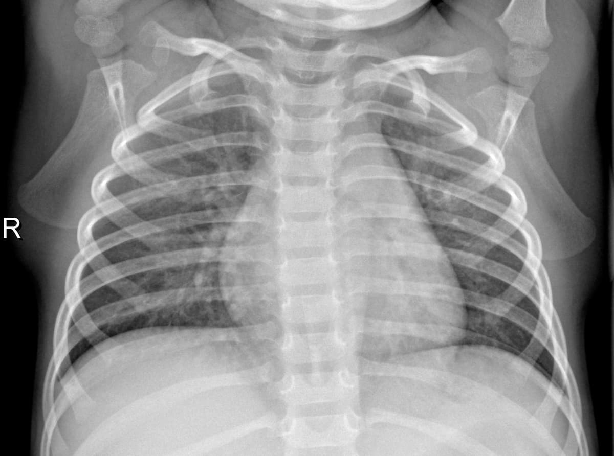 Radiografia Normal — NIH Chest X-ray14