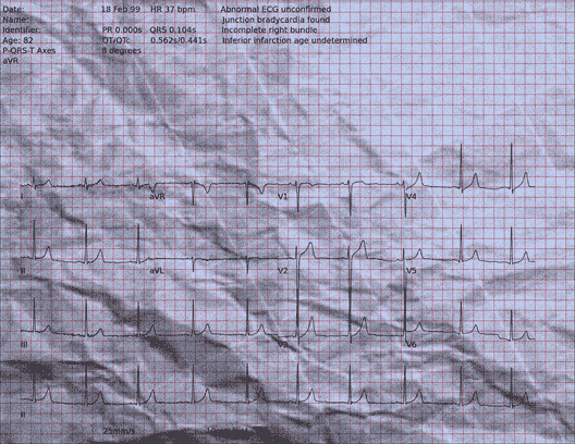 Normal ECG — PTB-XL