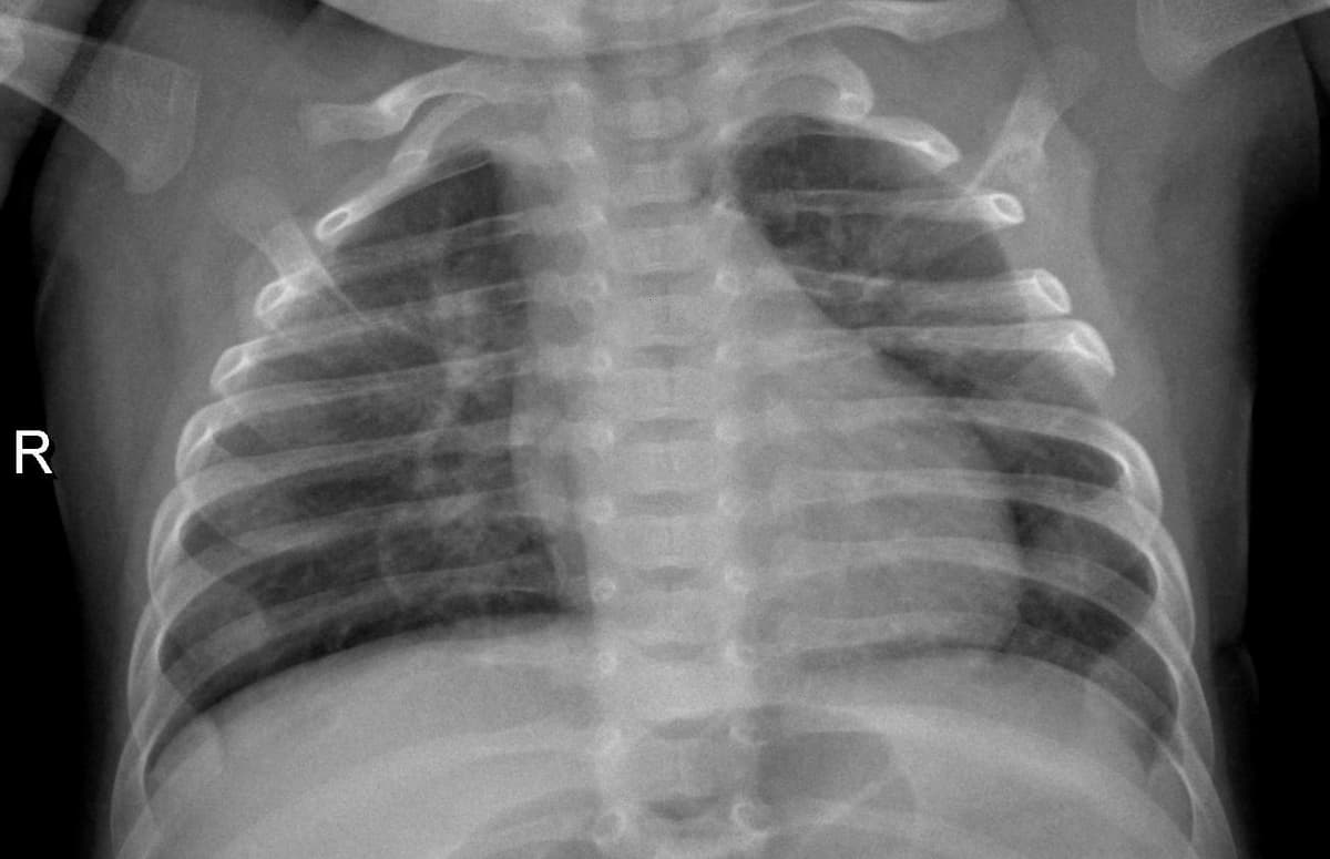 Pneumonia — NIH Chest X-ray14