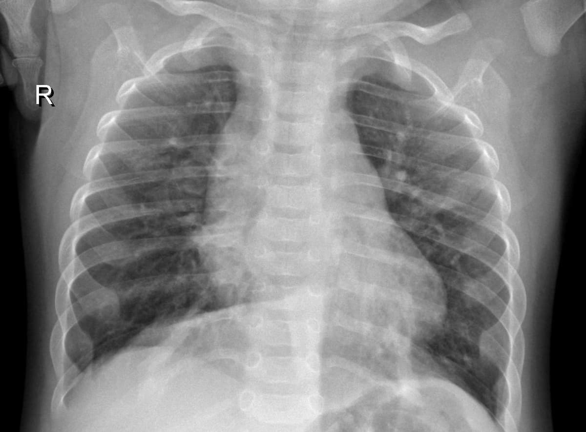 Pneumonia — NIH Chest X-ray14