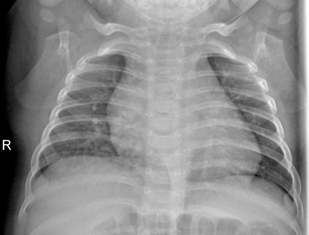 Radiografia Normal — NIH Chest X-ray14