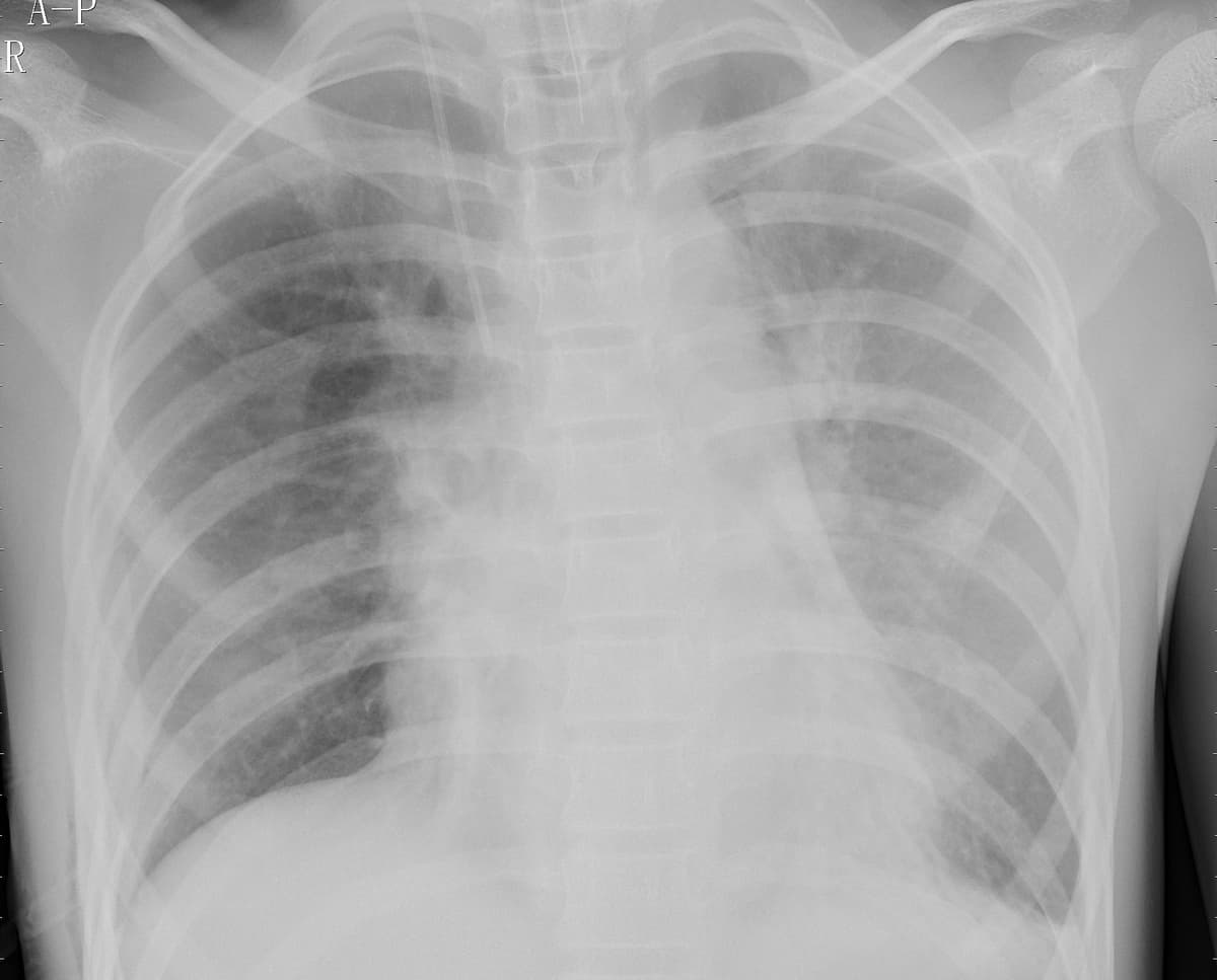Pneumonia — NIH Chest X-ray14