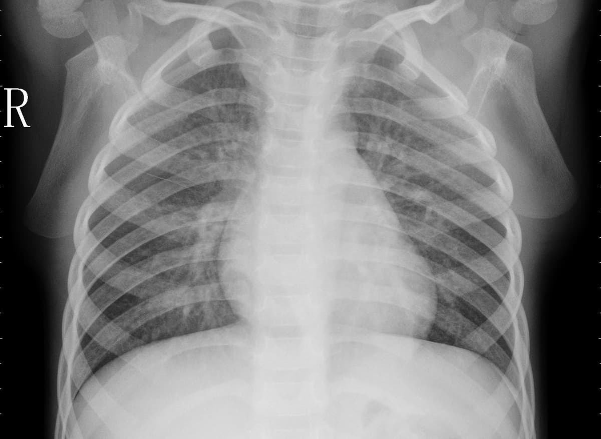 Pneumonia — NIH Chest X-ray14