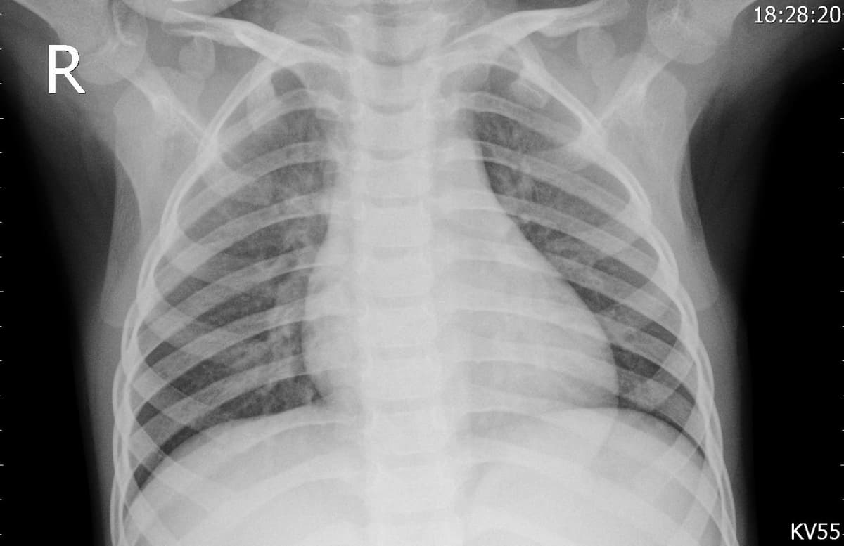 Pneumonia — NIH Chest X-ray14