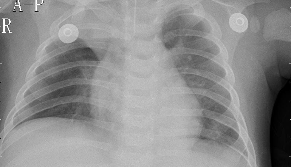 Pneumonia — NIH Chest X-ray14