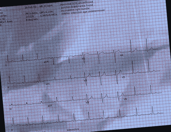 Normal ECG — PTB-XL