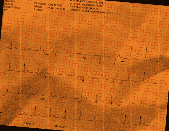 Left Bundle Branch Block — PTB-XL