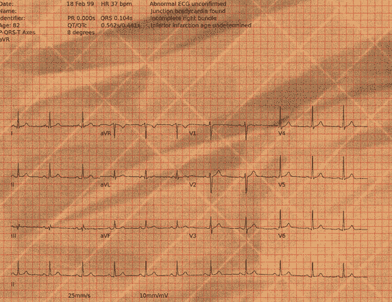 Normal ECG — PTB-XL