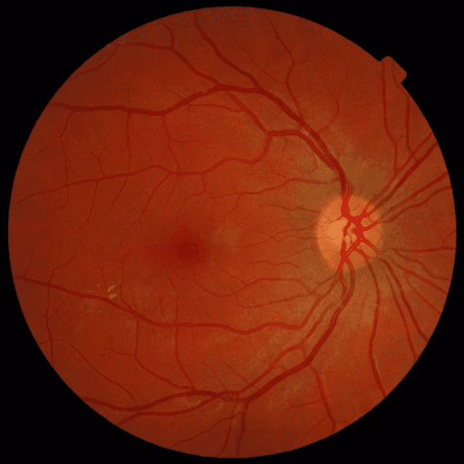 No Diabetic Retinopathy — MESSIDOR-2