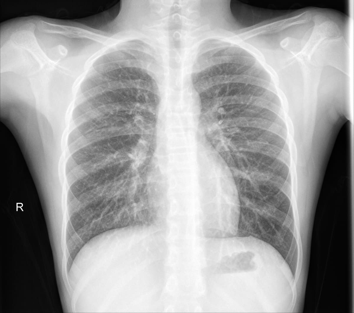 Radiografia Normal — NIH Chest X-ray14